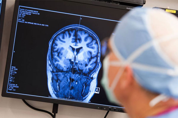 تشخیص بیماری صرع با ام آر آی