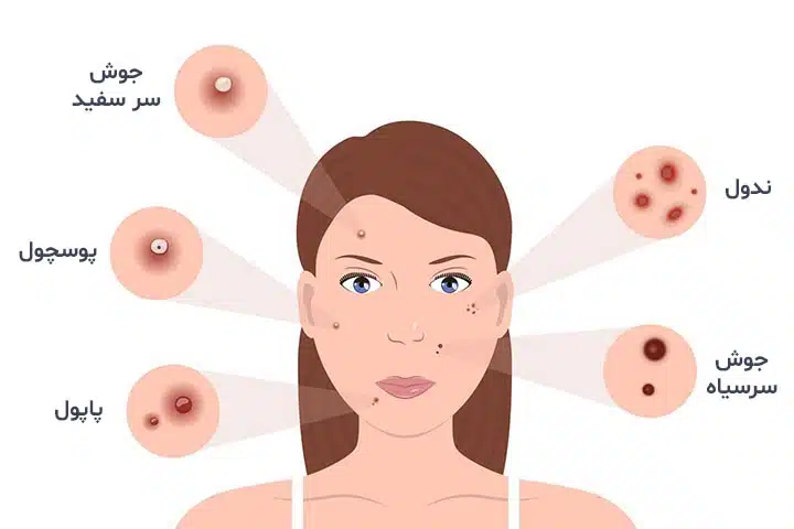 آکنه