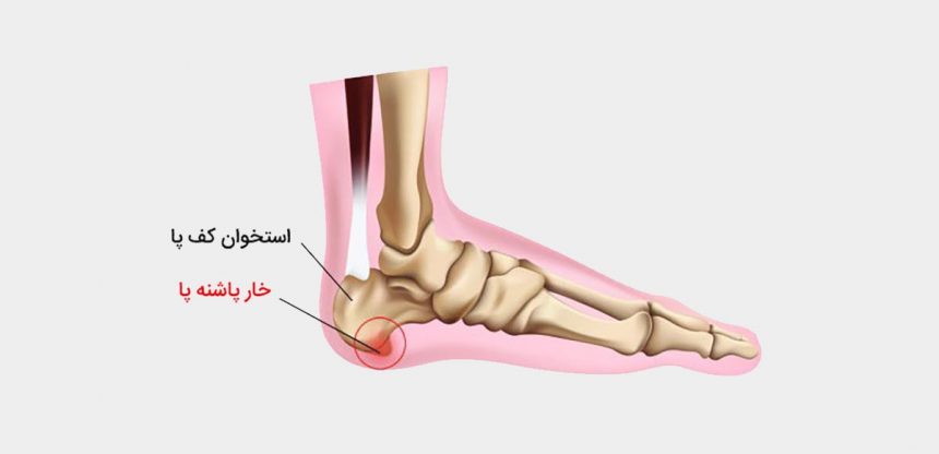 خار پاشنه