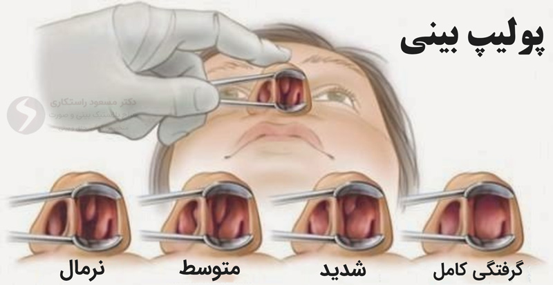 پولیپ بینی